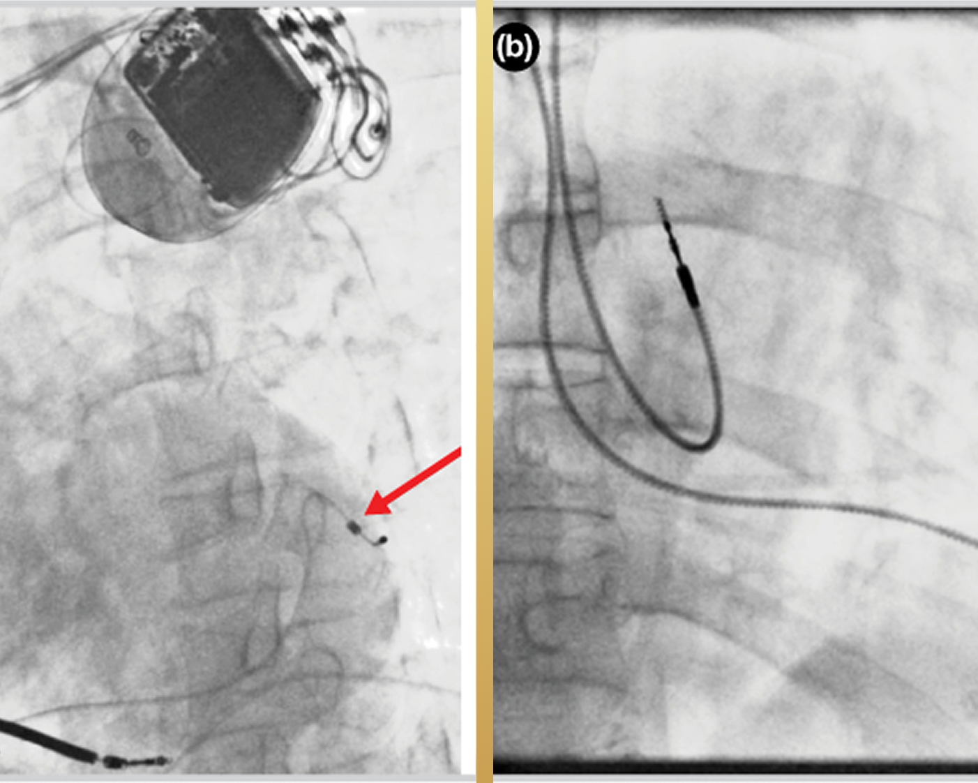 ICD-device-and-heart-rhythm
